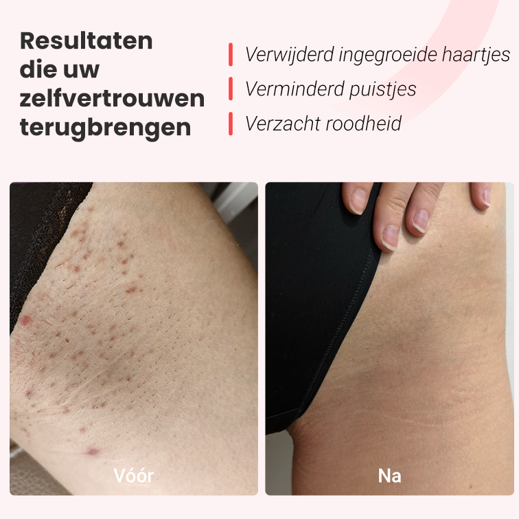 IPL foto-epilator