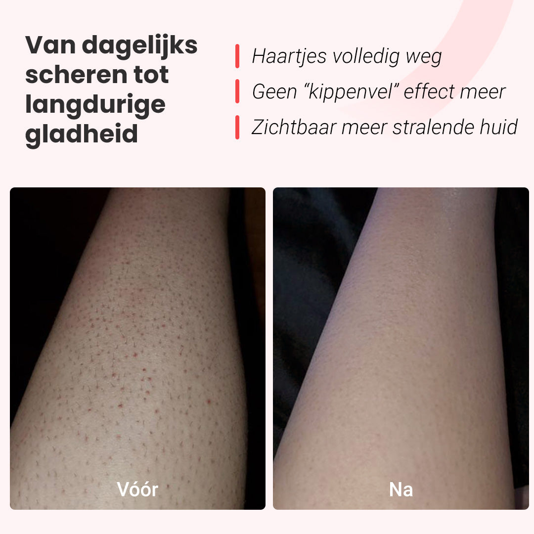 IPL foto-epilator